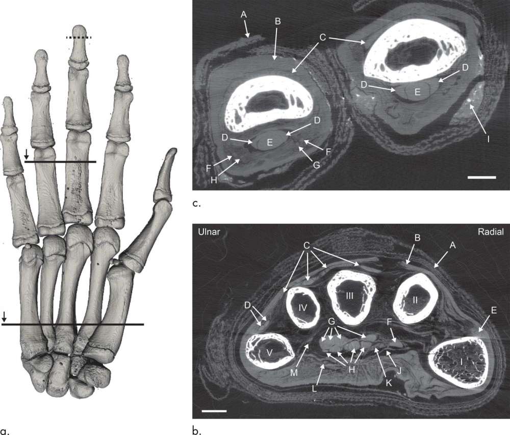 Tomografía computarizada de una mano momificada. 