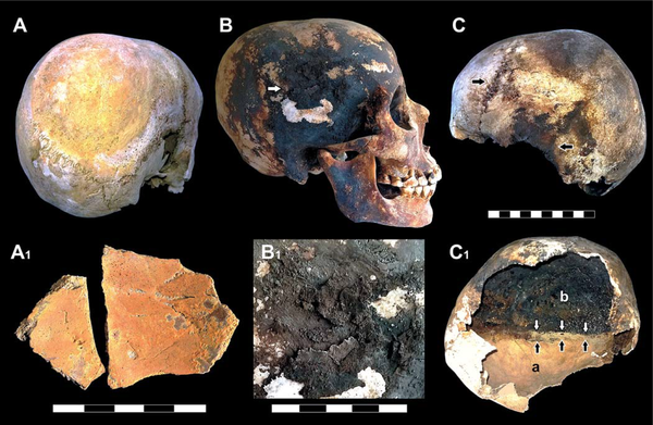 Incrustaciones de minerales rojos y negros en los cráneos de las víctimas. 